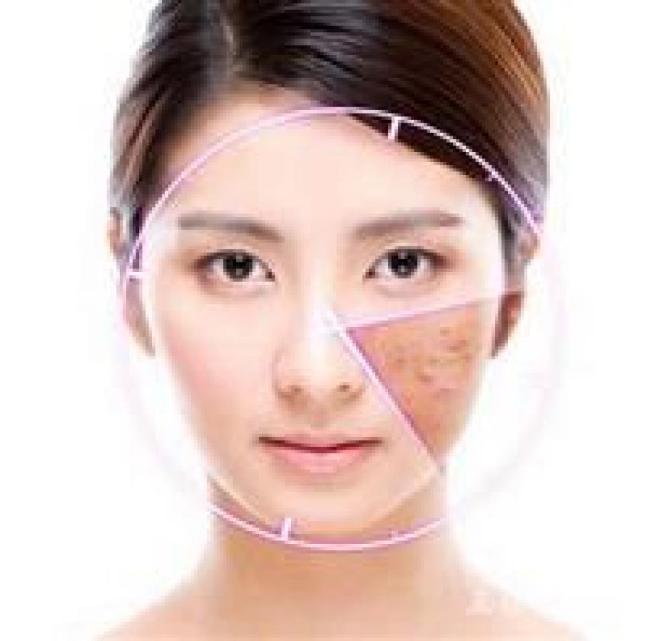 教你祛痘小秘方