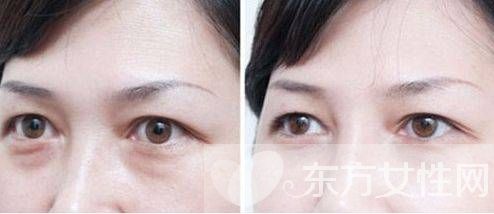 眼部脂肪粒怎么去除 六大方法幫你趕跑脂肪粒