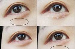 眼部脂肪粒怎么去除 六大方法幫你趕跑脂肪粒