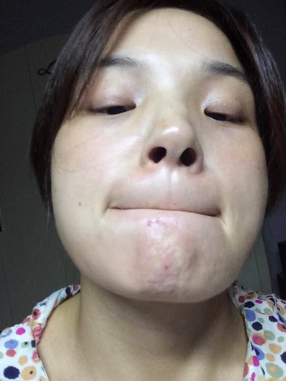 引起下巴痤瘡的六大原因 千萬不能用手擠