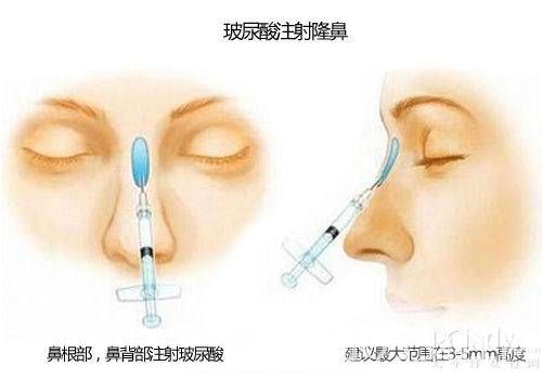 你知道注射玻尿酸需要多少錢嗎