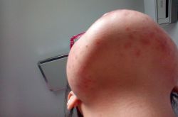 引起下巴痤瘡的六大原因 千萬不能用手擠