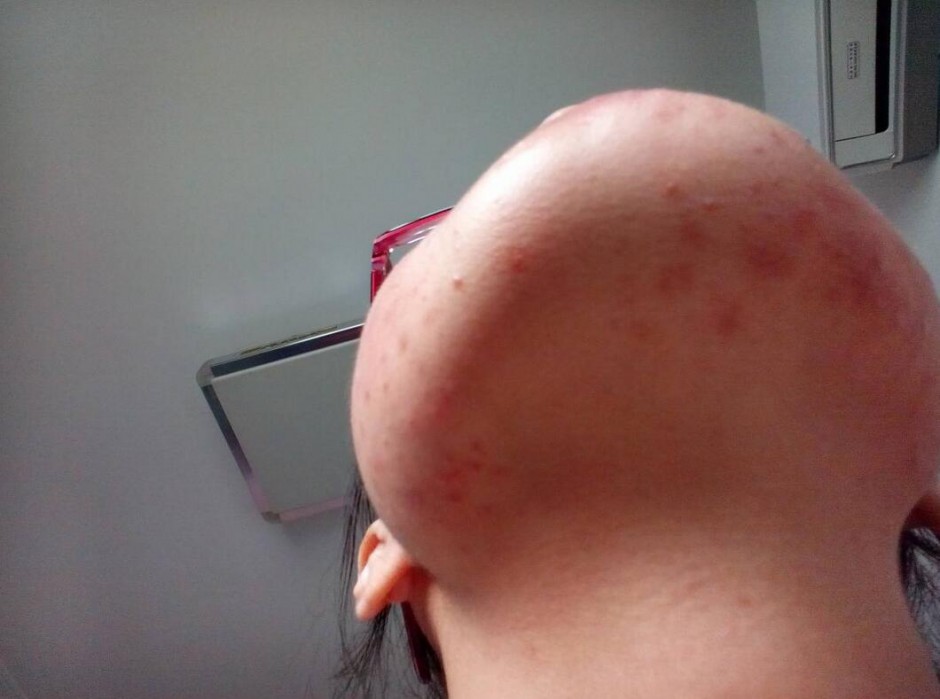 引起下巴痤瘡的六大原因 千萬不能用手擠