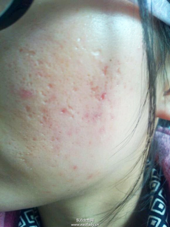 痘坑修復(fù)水能快速的解決痘印問題 是真的嗎