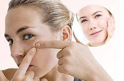 長痘痘不能吃什么 這4種食物千萬別碰