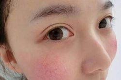 探究紅血絲形成原因 四小妙招去除紅血絲