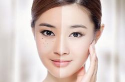 激光祛斑的危害有多大 如何做好術(shù)后護(hù)理