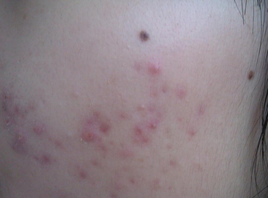 揭右臉長痘痘原因 三小妙招還你白嫩肌膚