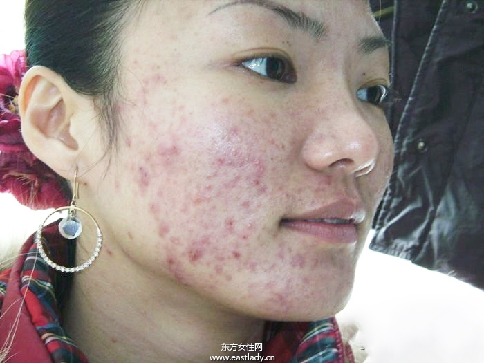 痘坑修復(fù)水能快速的解決痘印問(wèn)題 是真的嗎