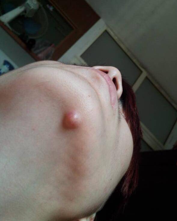 引起下巴痤瘡的六大原因 千萬不能用手擠