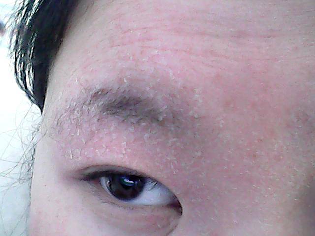 揭密臉上起皮五大原因 四招緩解皮膚干燥