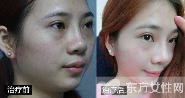 激光祛斑好不好 怎樣祛斑最有效