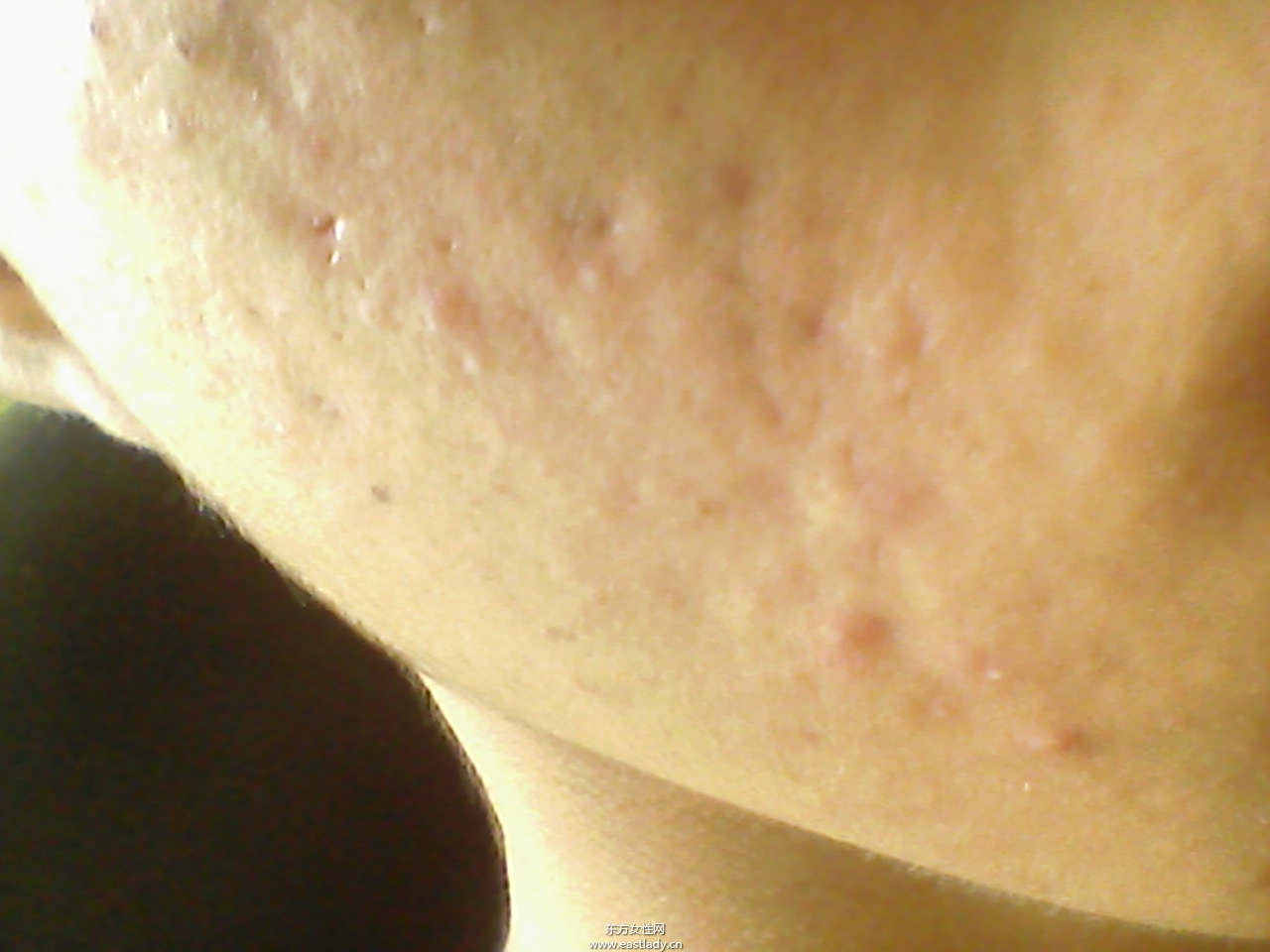 痘坑修復(fù)水能快速的解決痘印問題 是真的嗎