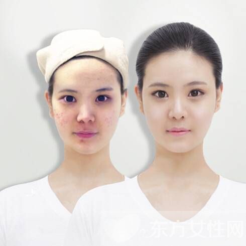 祛痘小妙招 只留青春不留痘