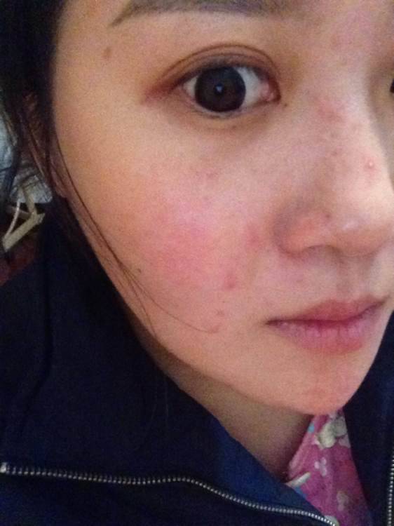 揭右臉長痘痘原因 三小妙招還你白嫩肌膚