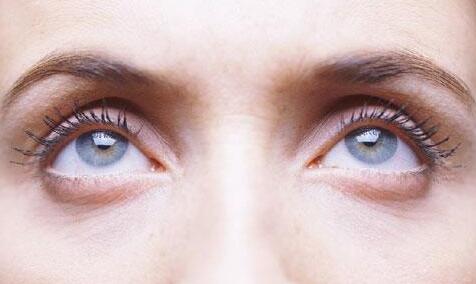 眼袋大怎么辦呢 專家教你該如何去除大眼袋