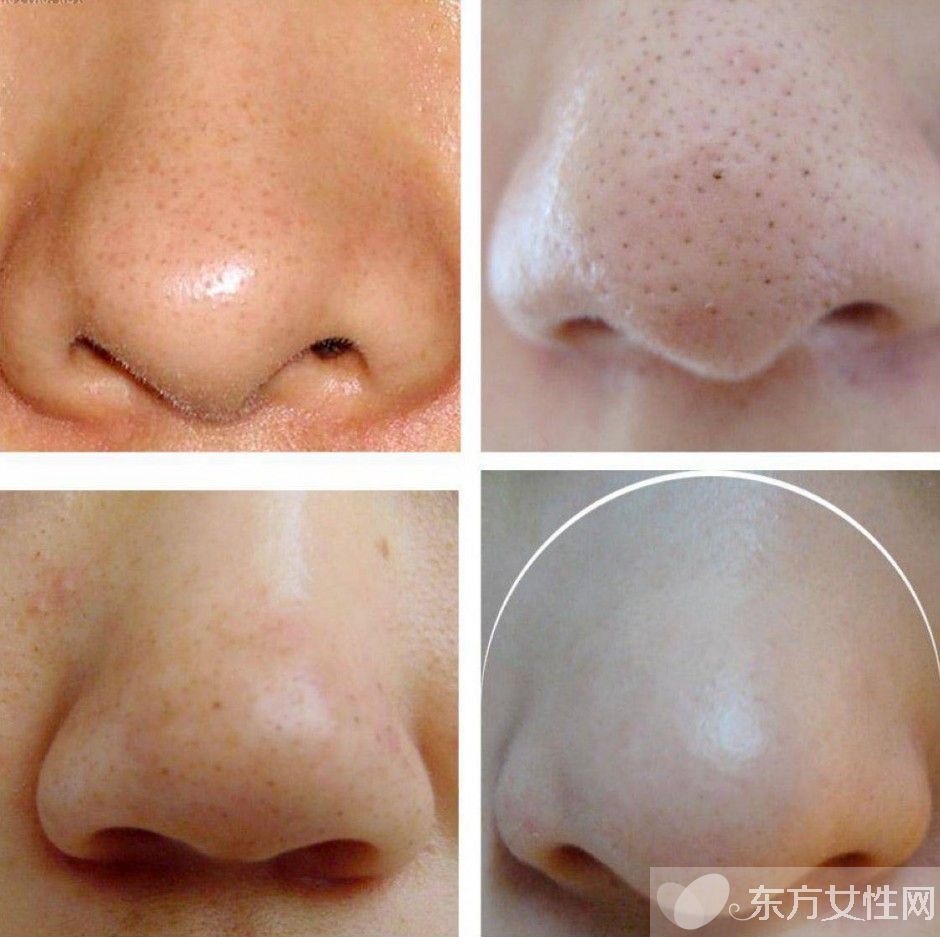 最有效去黑頭方法推薦 日常去黑頭小妙招超管用