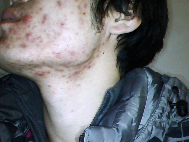 引起下巴痤瘡的六大原因 千萬不能用手擠