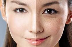 怎么樣去除色斑 去除色斑的六大神奇小妙招
