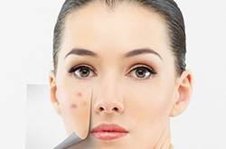 揭右臉長痘痘原因 三小妙招還你白嫩肌膚