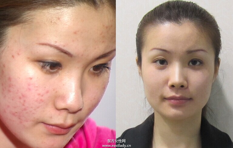 五個簡單小妙招 讓你跟青春痘疤痕say goodbye