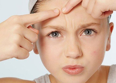 五個(gè)簡(jiǎn)單小妙招 讓你跟青春痘疤痕say goodbye