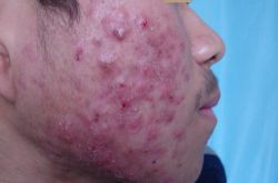 6個(gè)引起痤瘡粉刺的原因 治療痤瘡粉刺偏方推薦