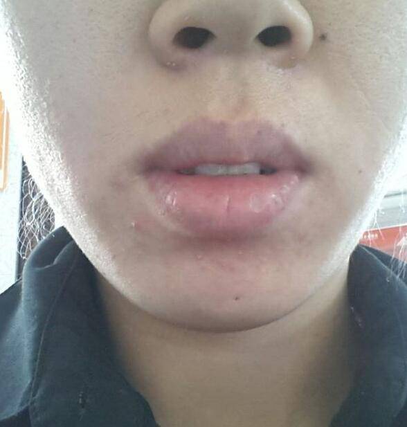 引起下巴痤瘡的六大原因 千萬不能用手擠