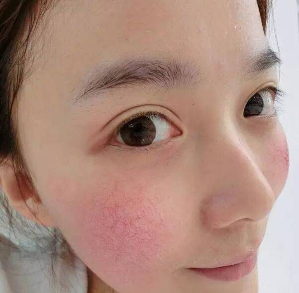 探究紅血絲形成原因 四小妙招去除紅血絲