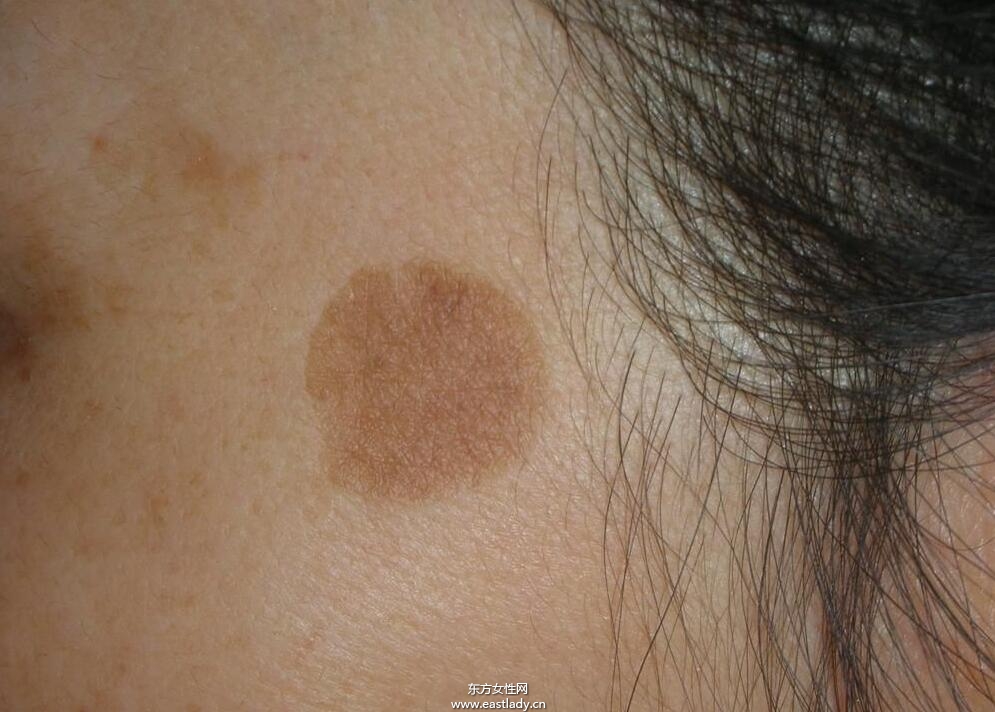 快速消除老年斑 老年斑的食療方法大全