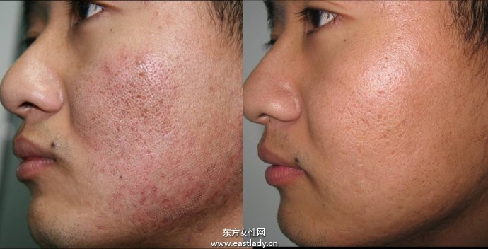 五個簡單小妙招 讓你跟青春痘疤痕say goodbye