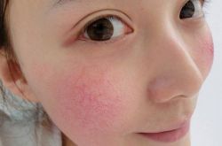 用什么可以去紅血絲 這么做可以快速去除紅血絲哦