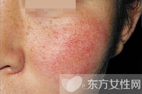 用什么可以去紅血絲 這么做可以快速去除紅血絲哦