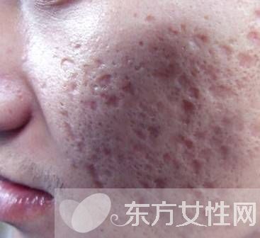 怎么樣去痘疤 痘疤和痘印的區(qū)別