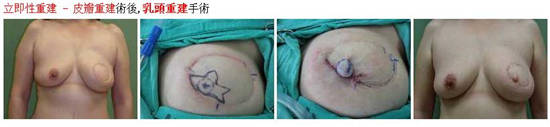 乳腺癌患者乳房重建 重塑女人魅力