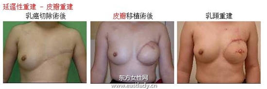 乳腺癌患者乳房重建 重塑女人魅力