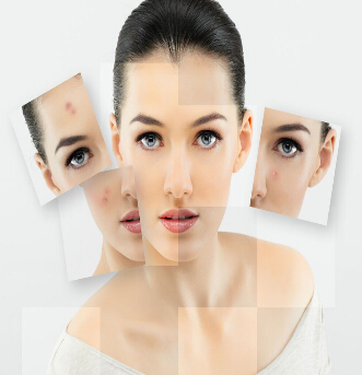 激光祛斑術前準備 激光祛斑注意事項