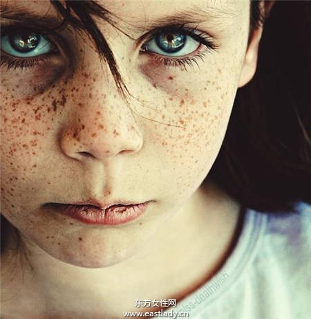 女人食鹽過多容易長雀斑