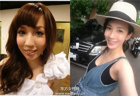 整容手術以改善咬合不正下顎突出 明星也這樣做