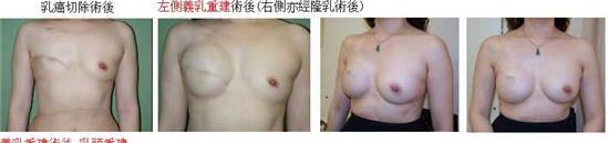 乳腺癌患者乳房重建 重塑女人魅力