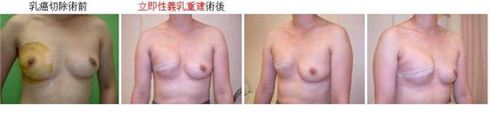 乳腺癌患者乳房重建 重塑女人魅力