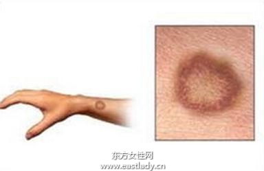 夏季要注意防治癬病