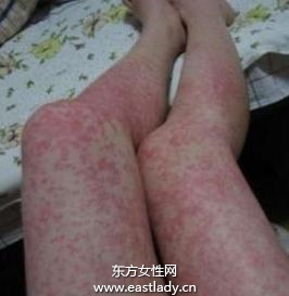 過敏體質(zhì)者要謹(jǐn)防皮膚過敏