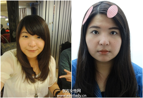 雙眼皮該縫還是該割 要根據(jù)眼型來選擇