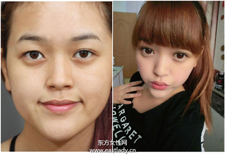 雙眼皮該縫還是該割 要根據(jù)眼型來選擇