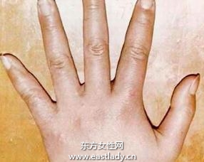 疥瘡的最佳治療方法