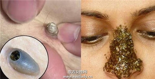 黑頭粉刺千萬(wàn)不能擠 這樣去黑頭 讓你擺脫 草莓鼻