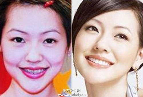 Angelababy 小S也做牙齒矯正 成功瘦小臉