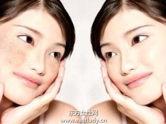 三種不同色斑種類治療方法不同