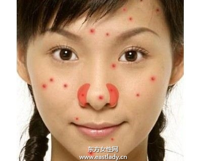 痘痘分級(jí)的常用標(biāo)準(zhǔn)